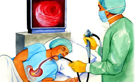 Chuyên gia tiêu hóa chỉ rõ 4 nhóm đối tượng cần nội soi dạ dày sớm