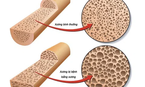Thiếu vitamin D: "Căn bệnh âm thầm" dễ bị bỏ qua