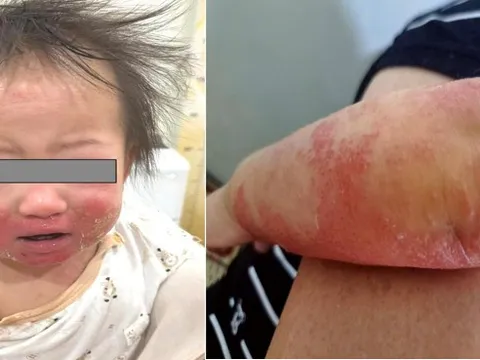 Cảnh giác viêm da cơ địa mùa hanh khô