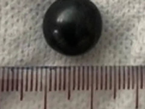 Nội soi gắp dị vật là viên bi trong mũi trẻ 3 tuổi