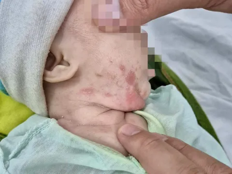 Điều trị cho bé gái 2 tháng tuổi mắc giang mai bẩm sinh