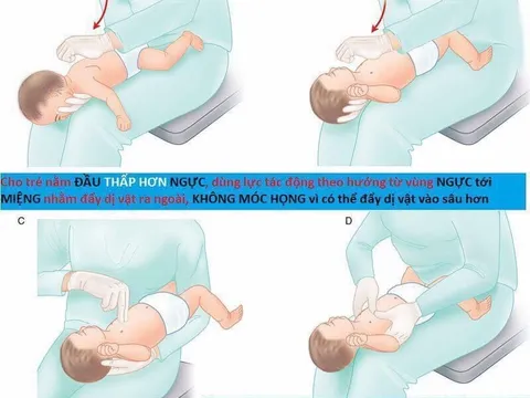 Hướng dẫn cách thực hiện thủ thuật Heimlich giúp cứu người bị hóc dị vật