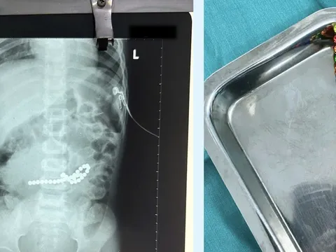 Thủng 8 lỗ ở ruột vì nuốt 31 viên nam châm đồ chơi